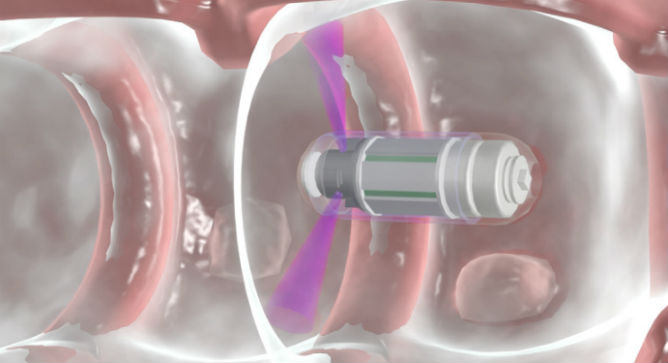 The Check-Cap capsule as it looks passing through the colon.