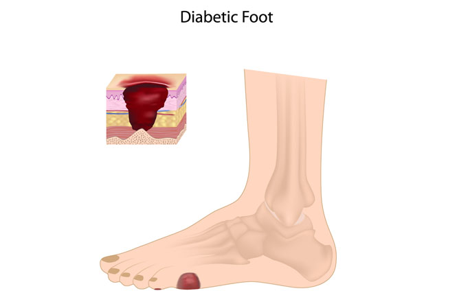 Diabetic foot ulcer. (Illustration by Shutterstock)