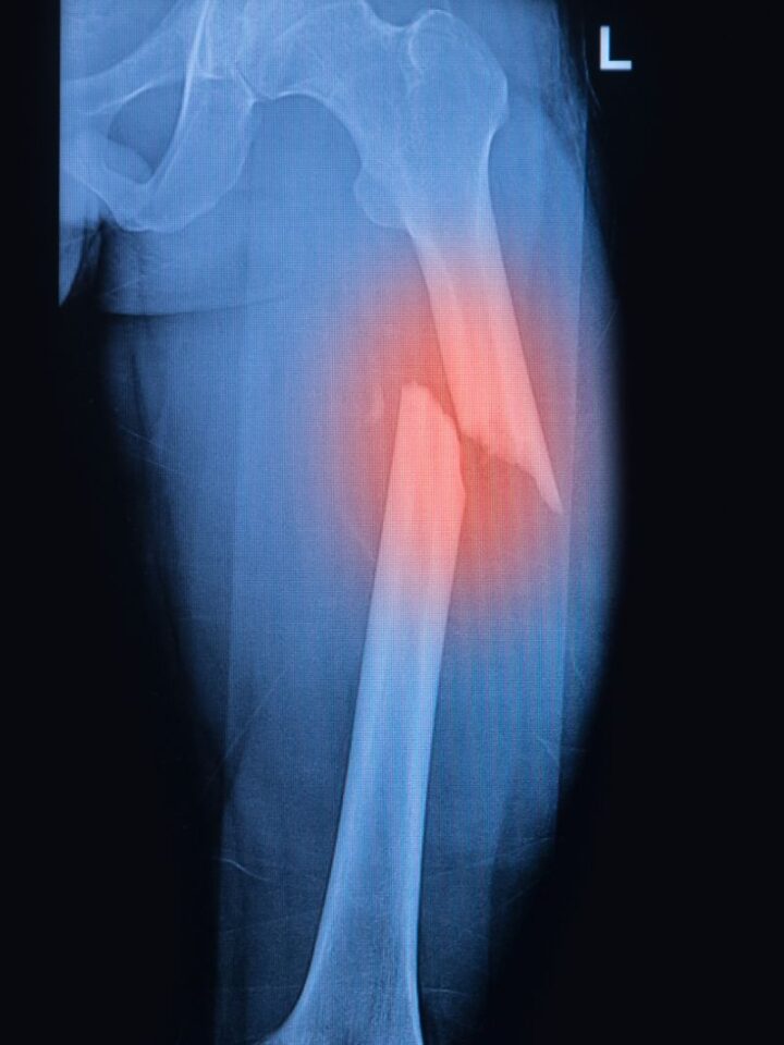 Image of fractured femur via Shutterstock.com