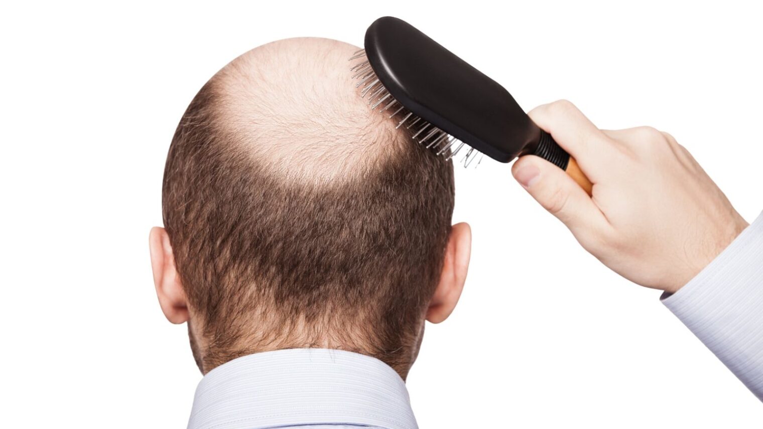 Cure for male baldness with no sexual side effects? - ISRAEL21c