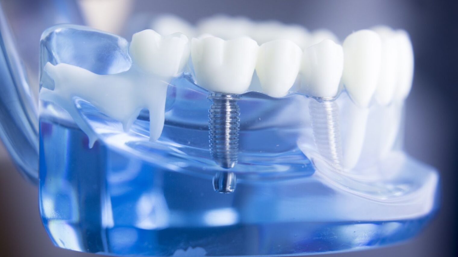 Dental implant image by Edward Olive/Shutterstock.com