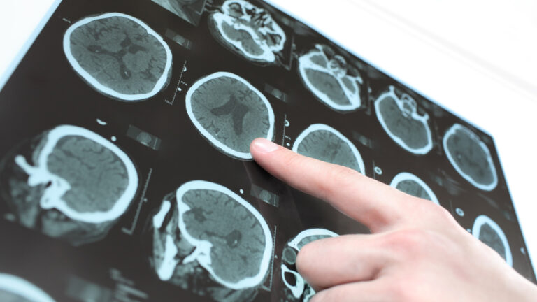 Brain scan of patient with Parkinson's. Photo via Shutterstock