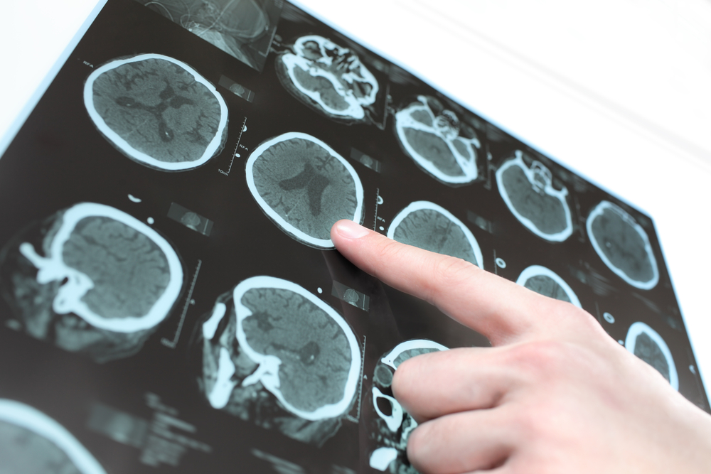 Brain scan of patient with Parkinson's. Photo via Shutterstock