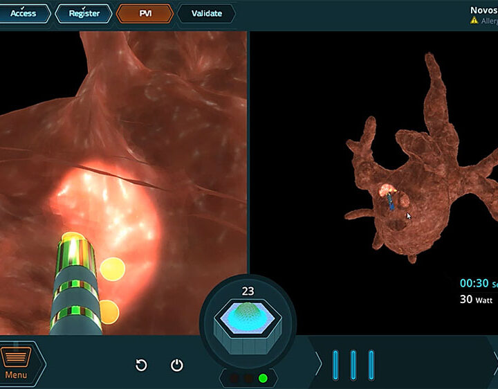 Screenshot showing EPD Solutions’ system navigating within a 3D segmented CT image to assess heart lesions before and immediately after ablation. Photo: courtesy