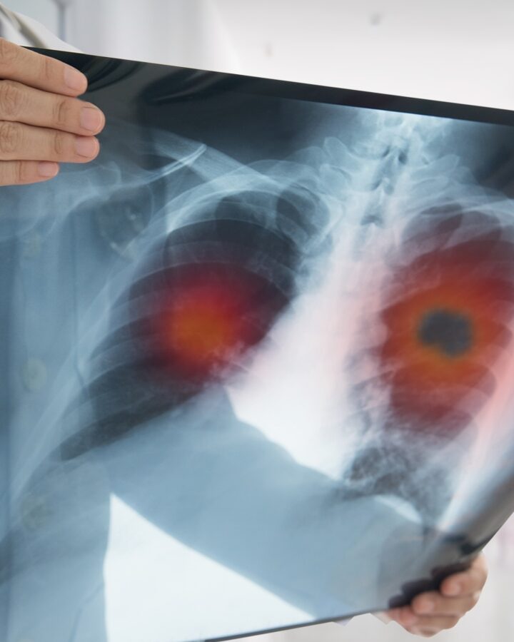 Lung cancer x-ray image via Shutterstock.com