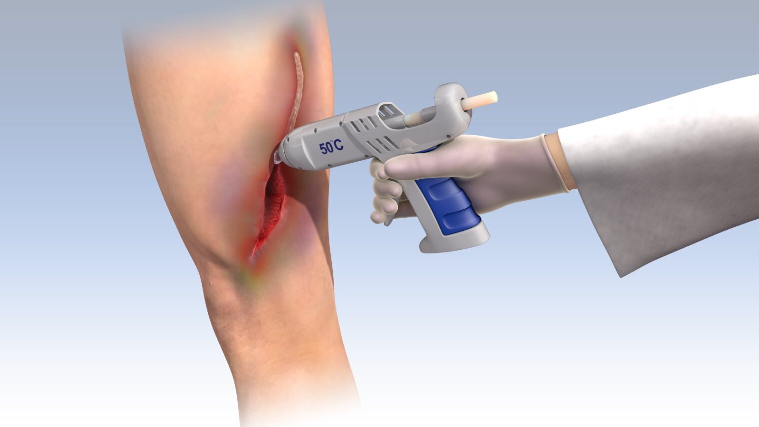 Illustration of the novel medical glue being applied on an incision using a hot-glue gun. Photo courtesy of Technion Spokesperson