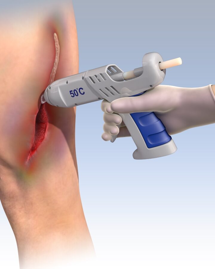 Illustration of the novel medical glue being applied on an incision using a hot-glue gun. Photo courtesy of Technion Spokesperson