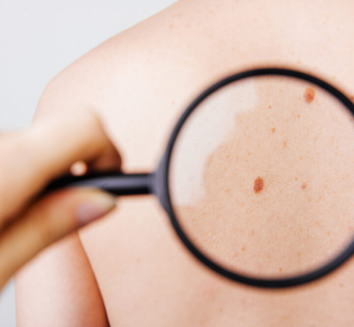 DermaDetect enables to diagnose skin conditions using a dedicated, AI-based app. Photo by Vulp via Shutterstock.com
