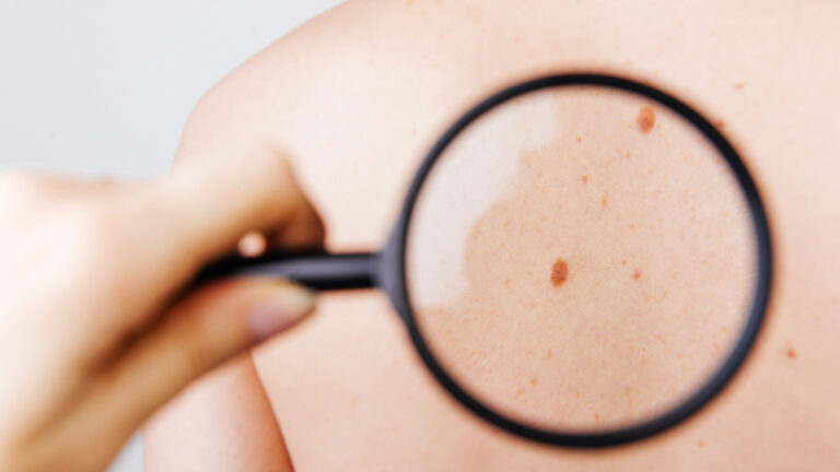 DermaDetect enables to diagnose skin conditions using a dedicated, AI-based app. Photo by Vulp via Shutterstock.com