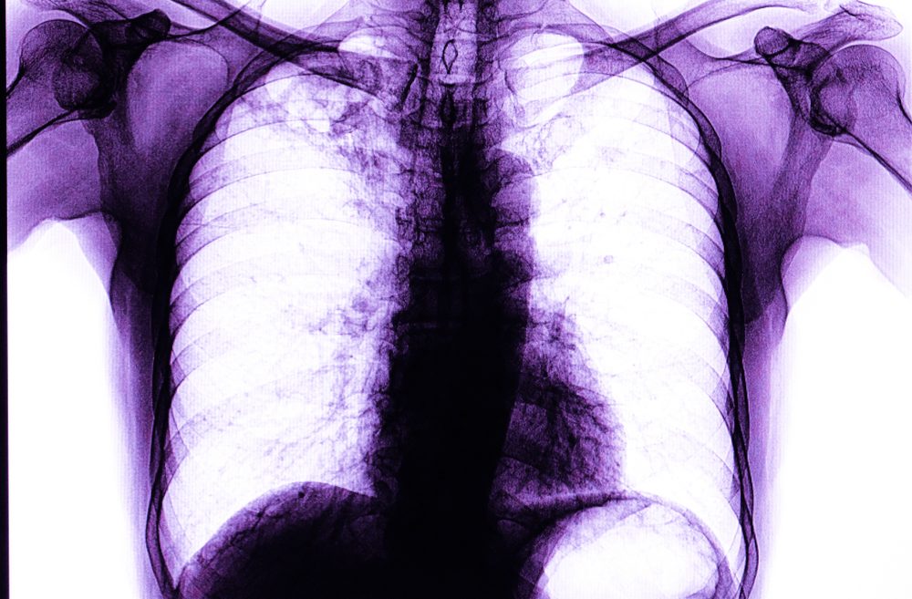 Xray of a patient with active pulmonary tuberculosis. Image by Shutterstock