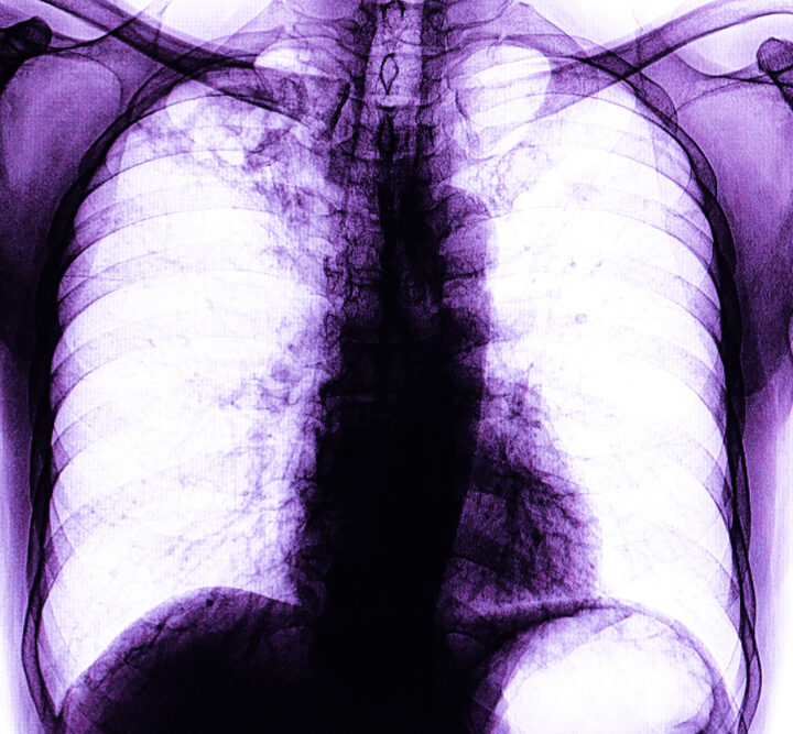 Xray of a patient with active pulmonary tuberculosis. Image by Shutterstock
