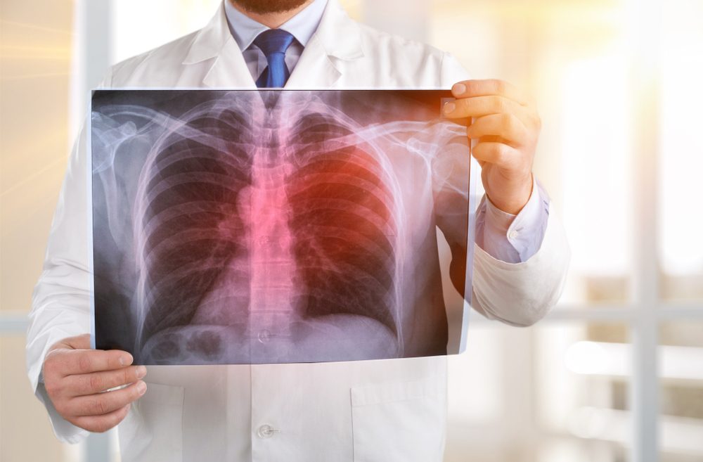 Image of lung cancer via Shutterstock.com