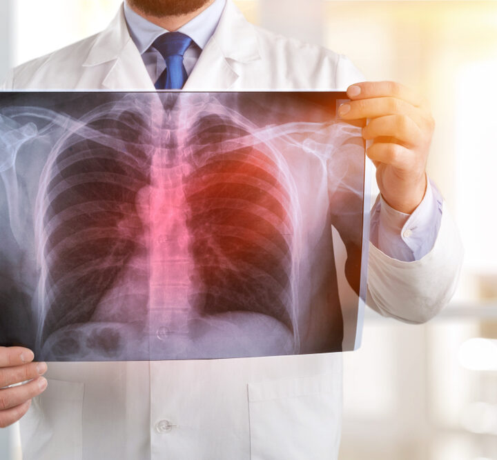 Image of lung cancer via Shutterstock.com