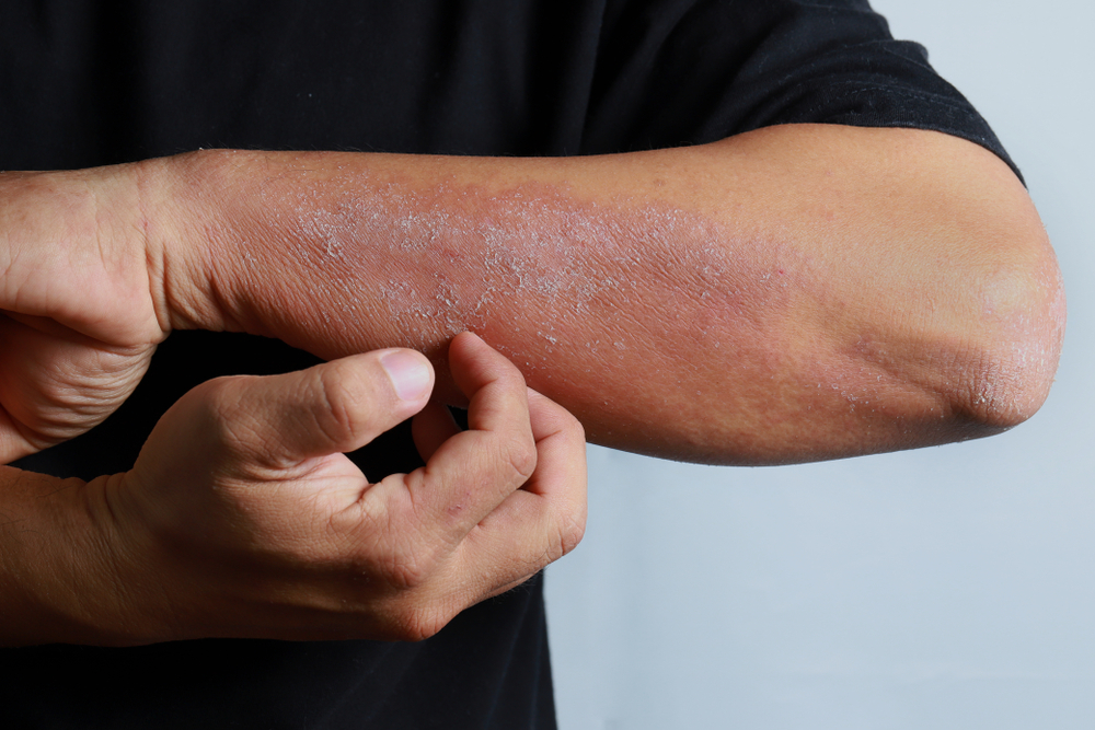 Atopic dermatitis is a chronic inflammatory disorder that currently has no cure. Photo by TY Lim/Shutterstock.com