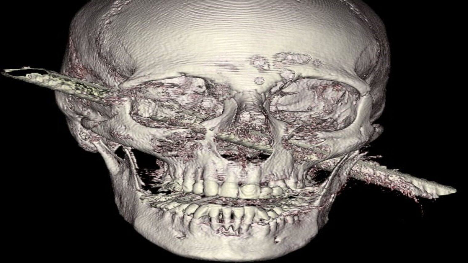 The iron rod rammed through Kamel Abdel Rahman’s skull, as seen in an imaging test. Photo courtesy of Hadassah Spokesperson