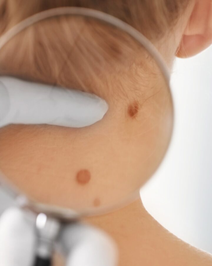 Melanoma is the least common and most lethal form of skin cancer. Image via Shutterstock.com