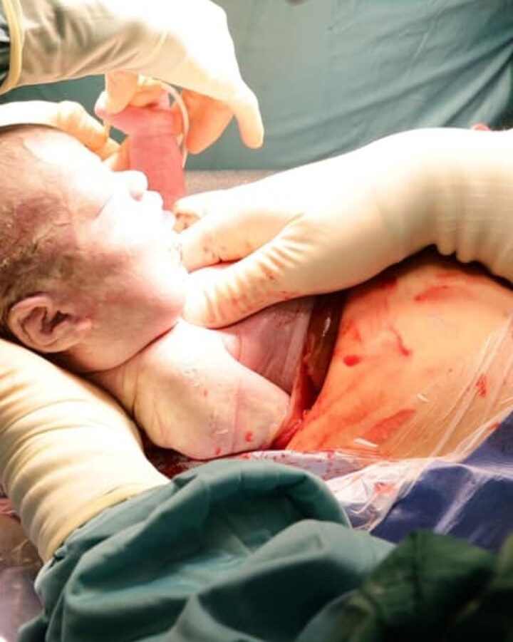 The baby born October 14, 2020, after an ex utero intrapartum procedure at Tel Aviv Sourasky Medical Center. Photo: courtesy