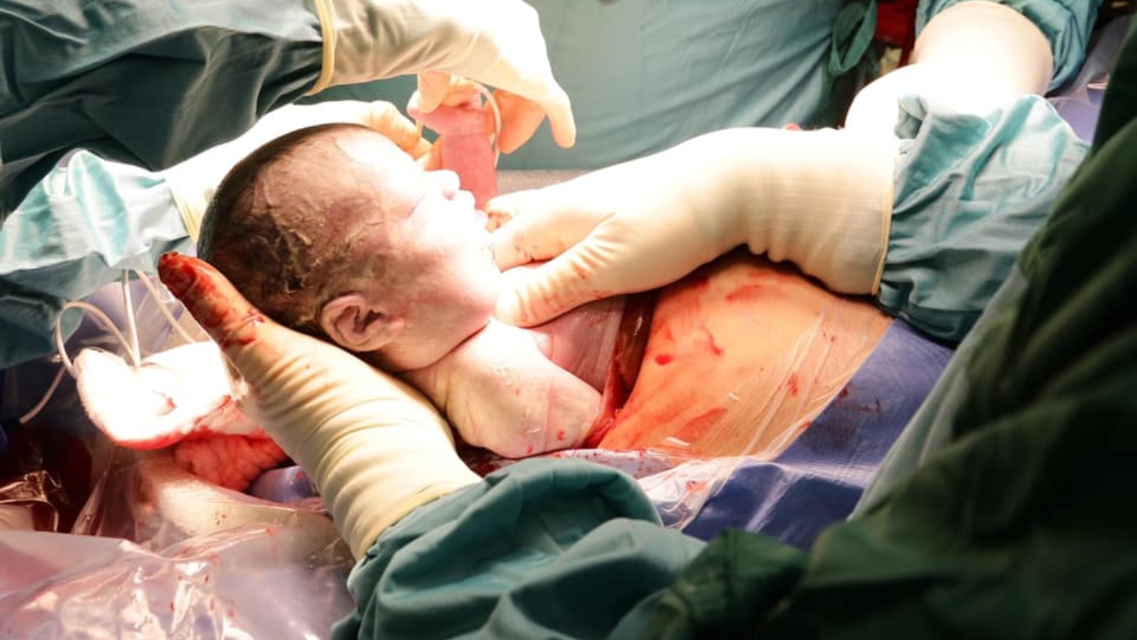 The baby born October 14, 2020, after an ex utero intrapartum procedure at Tel Aviv Sourasky Medical Center. Photo: courtesy