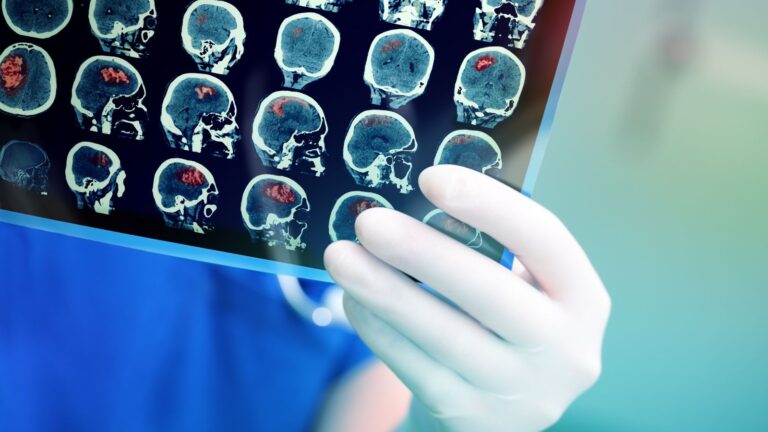 New study connects increased risk of stroke in younger people to Covid-19. Photo by Shutterstock