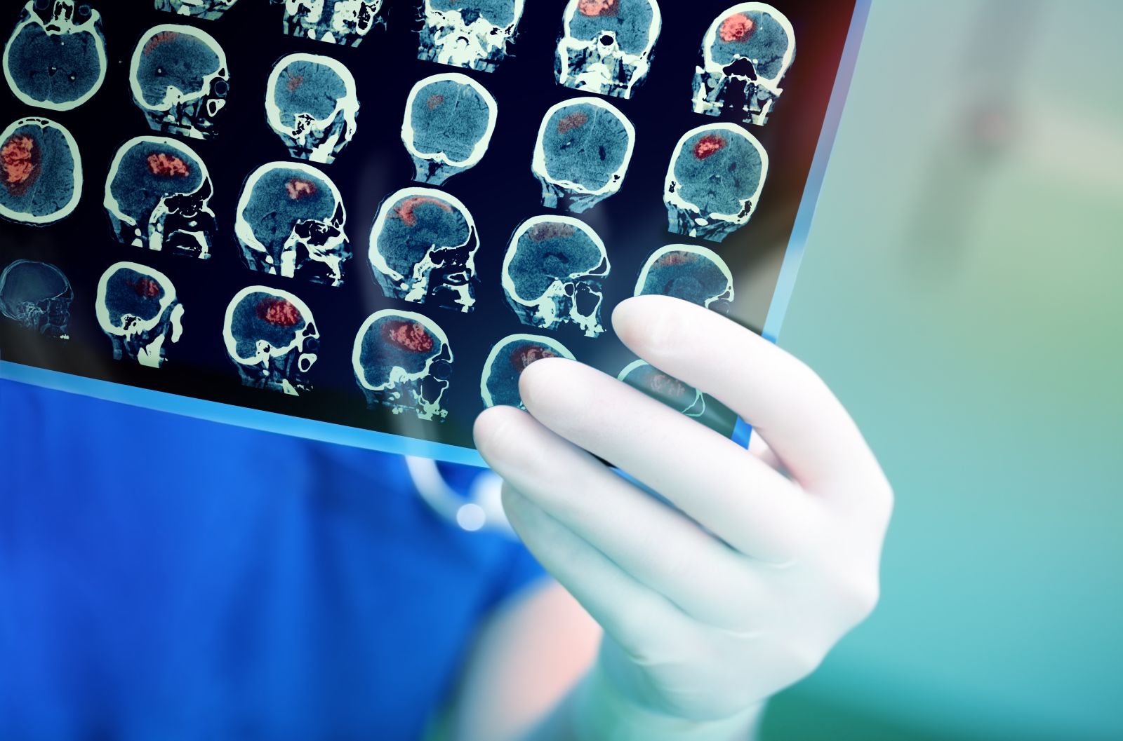 New study connects increased risk of stroke in younger people to Covid-19. Photo by Shutterstock