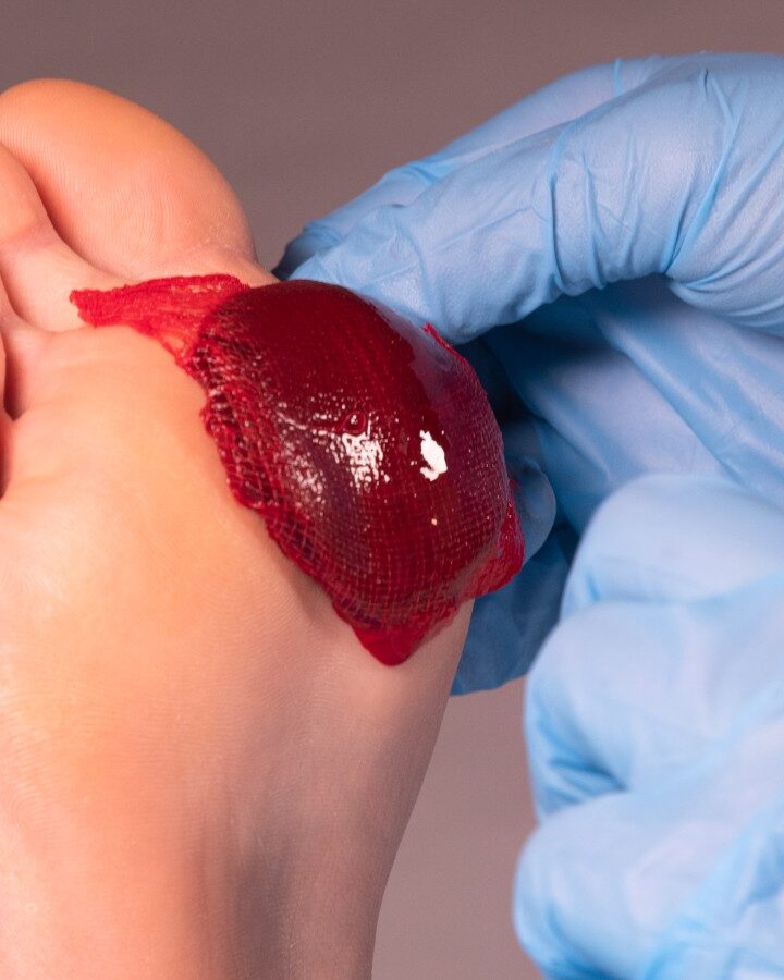 ActiGraft forms a blood clot outside the body, using the patient’s own blood, and is applied to trigger healing in a chronic wound. Photo courtesy of RedDress