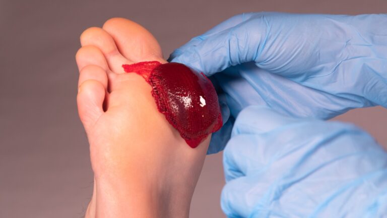 ActiGraft forms a blood clot outside the body, using the patient’s own blood, and is applied to trigger healing in a chronic wound. Photo courtesy of RedDress