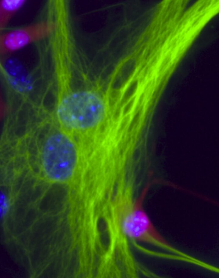A melanoma-astrocyte interaction.