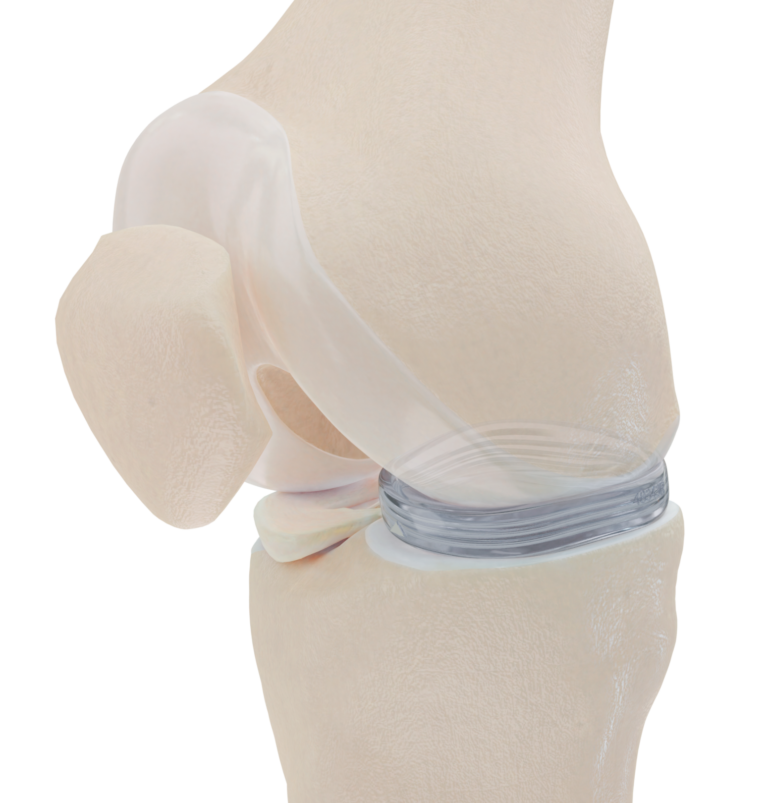New hope for people who â€˜kneedâ€™ a new meniscus