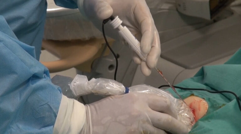 An ablation therapy device applies targeted heat to destroy the tumor. Photo courtesy of Techsomed