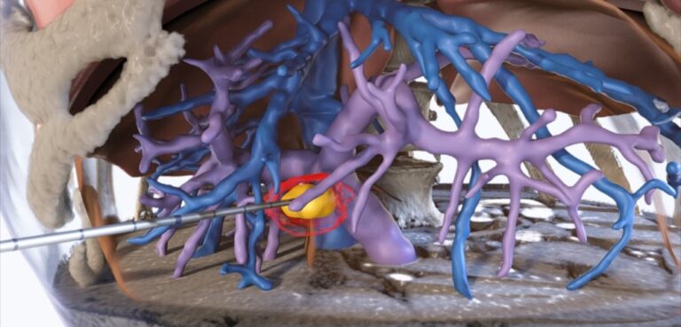 A 3D illustration where the tumor is yellow, ablation area is red, and blood vessels are blue and purple. Photo courtesy of Techsomed