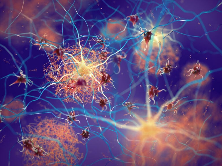 Amyloid plaques forming between neurons, disrupting nerve cell function in a brain with Alzheimer's disease (nobeastsofierce / Shutterstock.com)